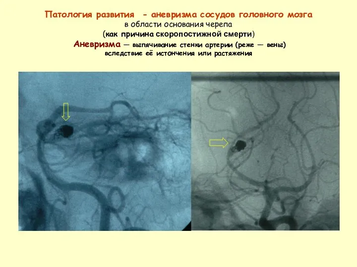 Патология развития - аневризма сосудов головного мозга в области основания черепа