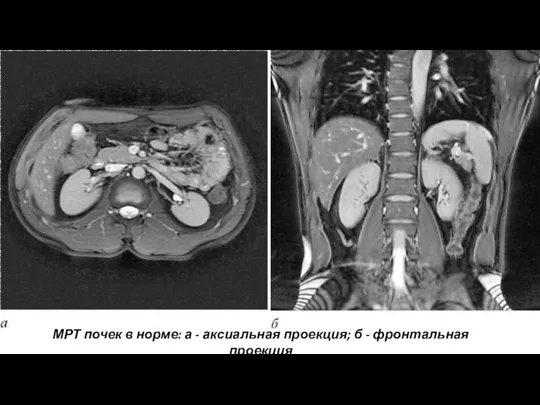 МРТ почек в норме: а - аксиальная проекция; б - фронтальная проекция