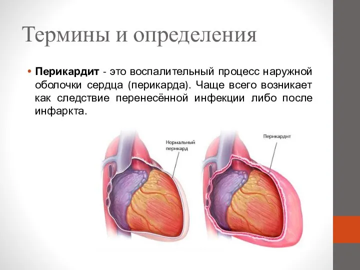 Термины и определения Перикардит - это воспалительный процесс наружной оболочки сердца