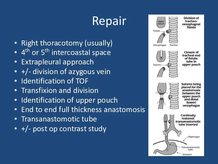 Repair Right thoracotomy (usually) 4th or 5th intercoastal space Extrapleural approach