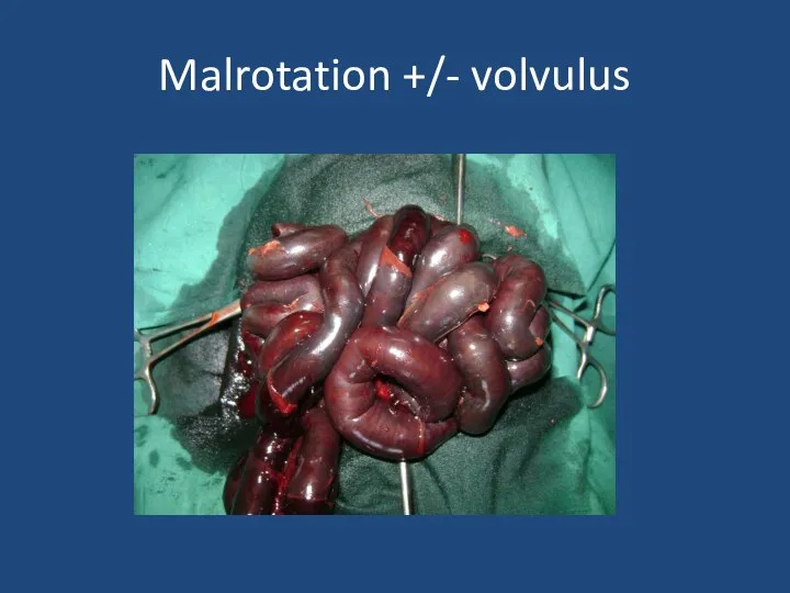 Malrotation +/- volvulus