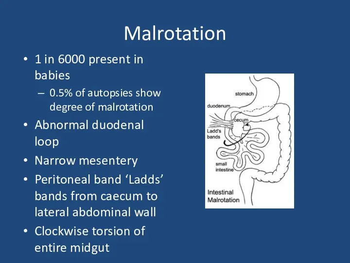 Malrotation 1 in 6000 present in babies 0.5% of autopsies show