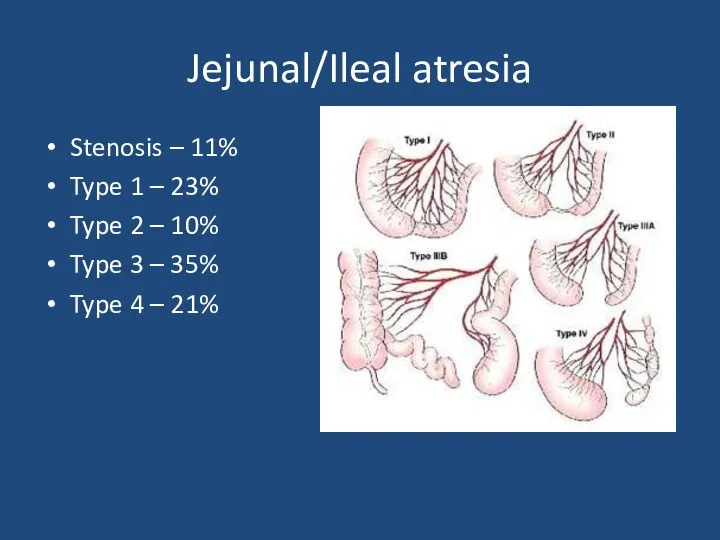 Jejunal/Ileal atresia Stenosis – 11% Type 1 – 23% Type 2