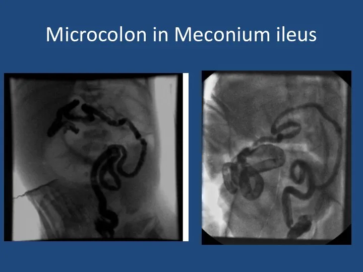 Microcolon in Meconium ileus