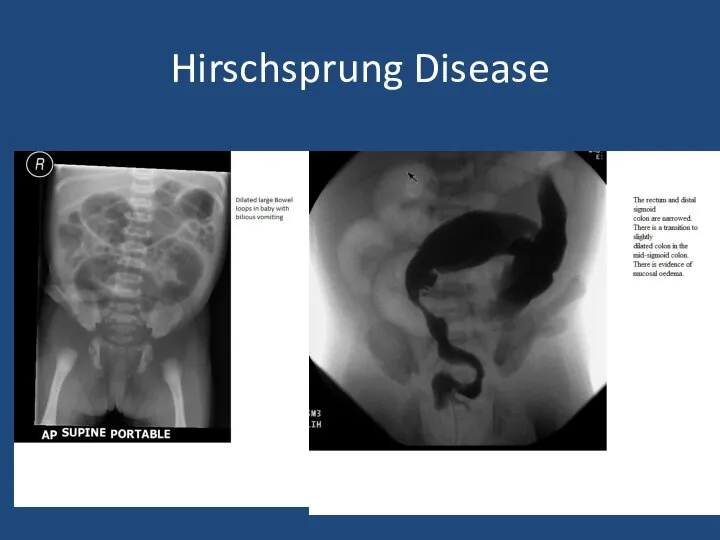 Hirschsprung Disease