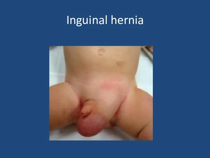 Inguinal hernia