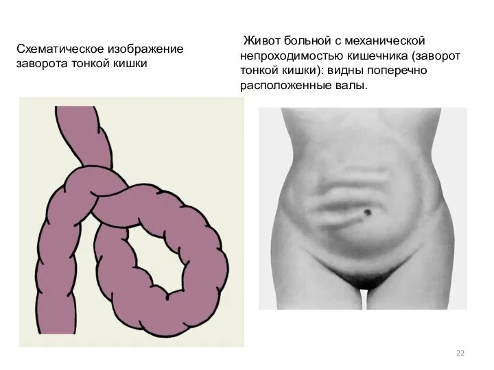 Схематическое изображение заворота тонкой кишки Живот больной с механической непроходимостью кишечника