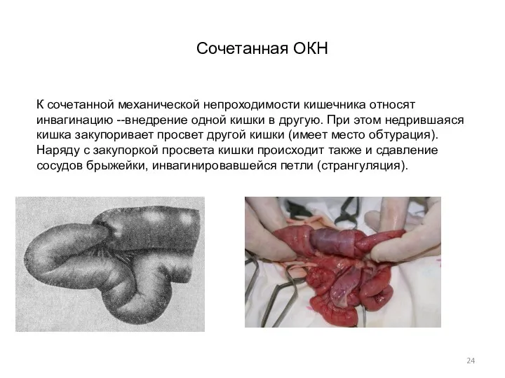 К сочетанной механической непроходимости кишечника относят инвагинацию --внедрение одной кишки в