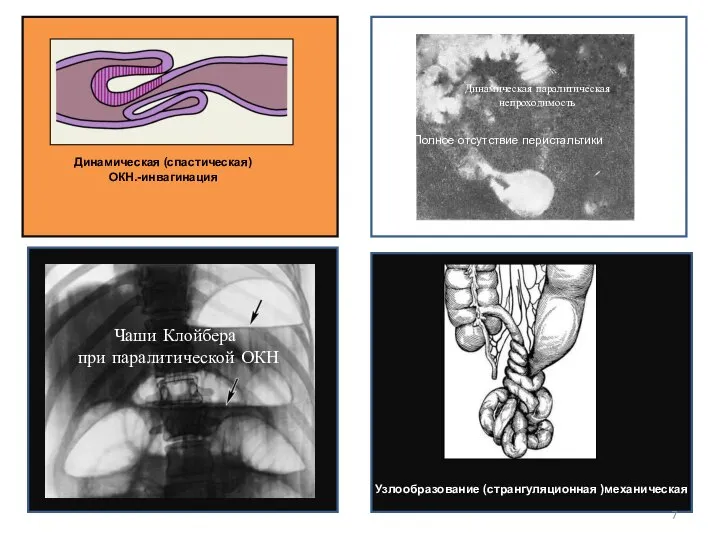 Динамическая (спастическая) ОКН.-инвагинация Полное отсутствие перистальтики Чаши Клойбера при паралитической ОКН