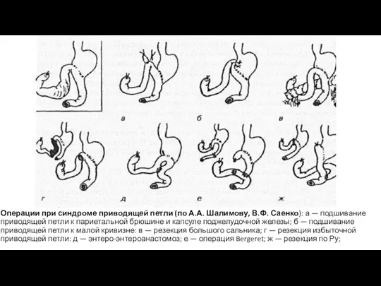 Операции при синдроме приводящей петли (по А.А. Шалимову, В.Ф. Саенко): а