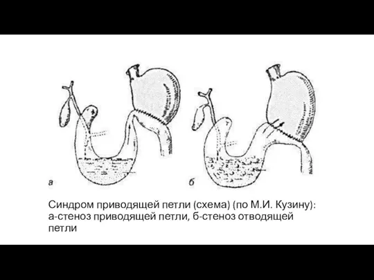 Синдром приводящей петли (схема) (по М.И. Кузину): а-стеноз приводящей петли, б-стеноз отводящей петли