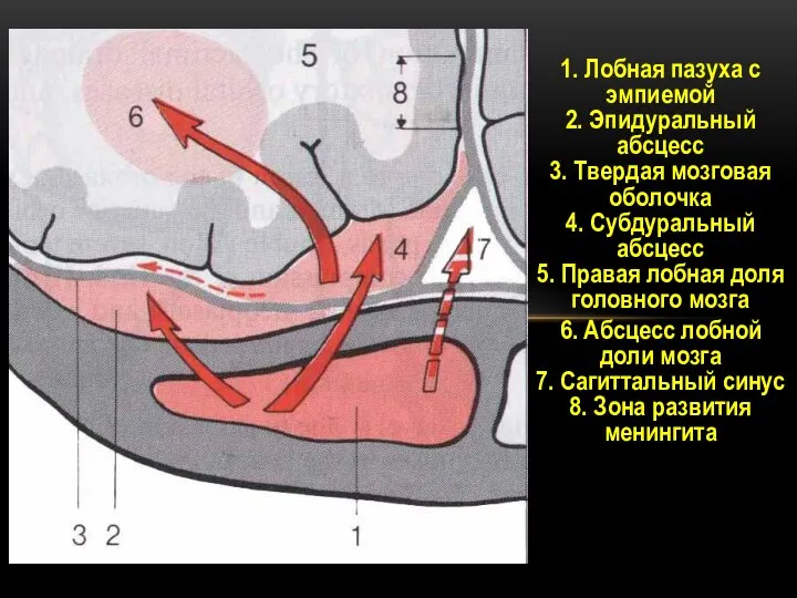 1. Лобная пазуха с эмпиемой 2. Эпидуральный абсцесс 3. Твердая мозговая