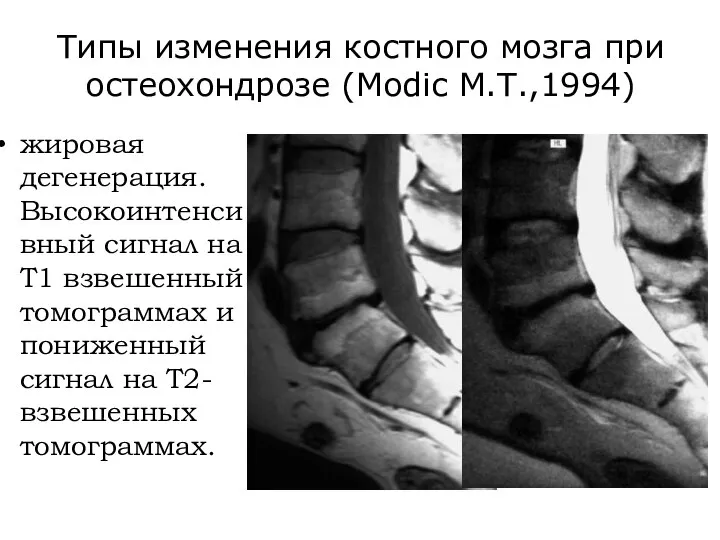 Типы изменения костного мозга при остеохондрозе (Modic M.T.,1994) жировая дегенерация. Высокоинтенсивный