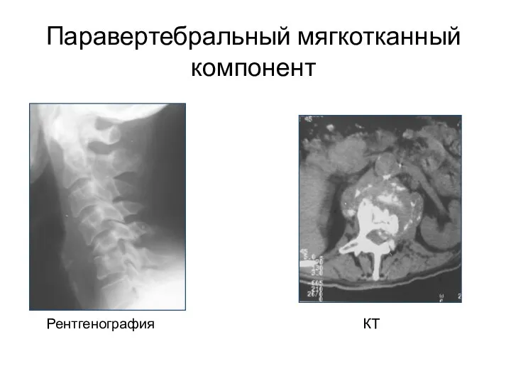 Паравертебральный мягкотканный компонент Рентгенография КТ