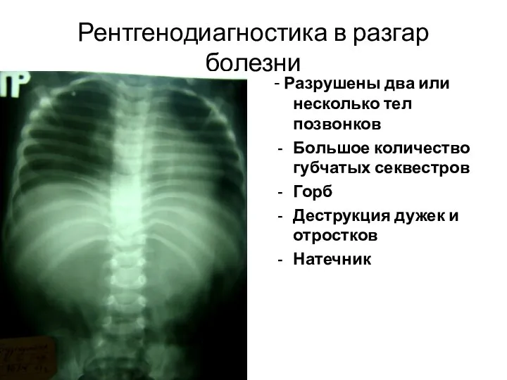 Рентгенодиагностика в разгар болезни - Разрушены два или несколько тел позвонков