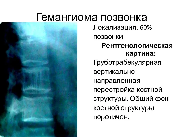 Гемангиома позвонка Локализация: 60% позвонки Рентгенологическая картина: Груботрабекулярная вертикально направленная перестройка