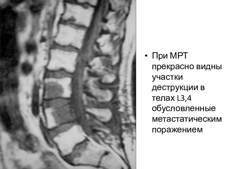 При МРТ прекрасно видны участки деструкции в телах L3,4 обусловленные метастатическим поражением