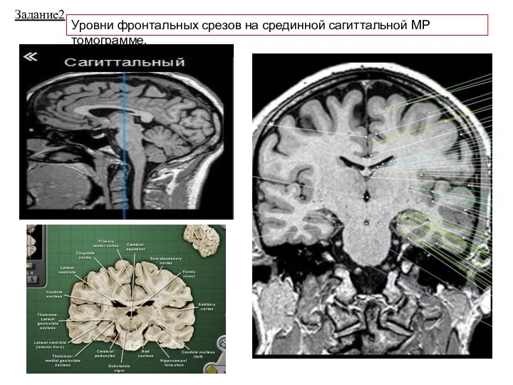 Уровни фронтальных срезов на срединной сагиттальной МР томограмме. Задание2