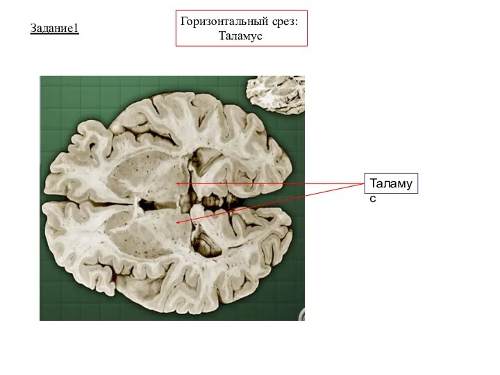 Задание1 Горизонтальный срез: Таламус Таламус