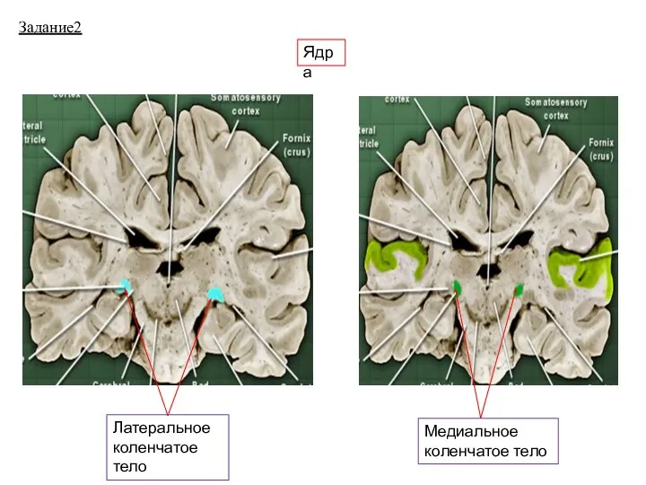 Задание2 Ядра Латеральное коленчатое тело Медиальное коленчатое тело