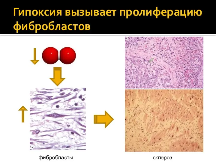 Гипоксия вызывает пролиферацию фибробластов фибробласты склероз