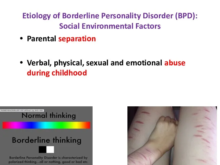 Etiology of Borderline Personality Disorder (BPD): Social Environmental Factors Parental separation