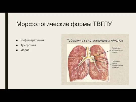 Морфологические формы ТВГЛУ Инфильтративная Туморозная Малая