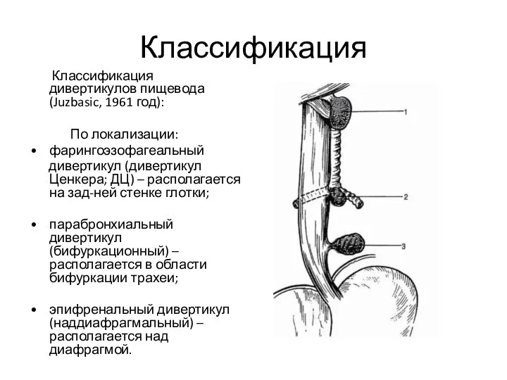 Классификация Классификация дивертикулов пищевода (Juzbasic, 1961 год): По локализации: • фарингоэзофагеальный