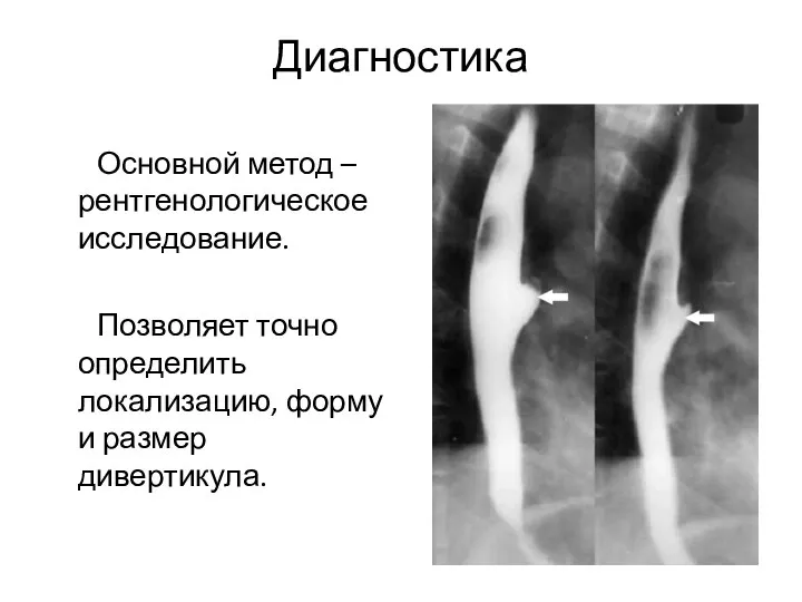 Диагностика Основной метод – рентгенологическое исследование. Позволяет точно определить локализацию, форму и размер дивертикула.