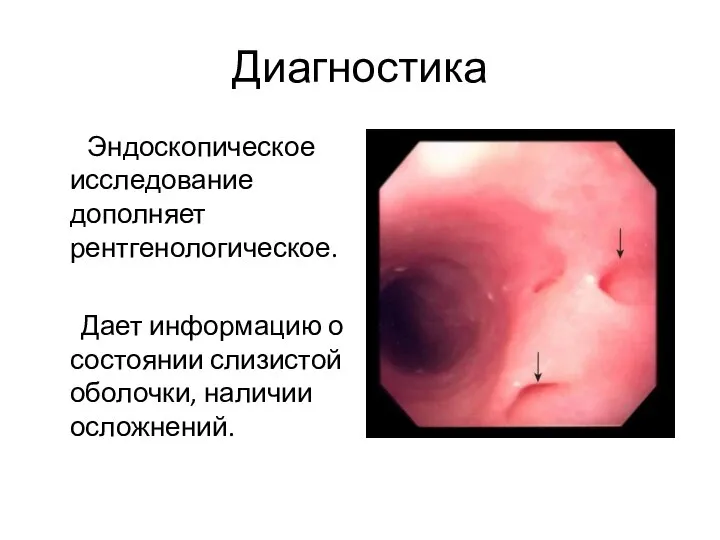 Диагностика Эндоскопическое исследование дополняет рентгенологическое. Дает информацию о состоянии слизистой оболочки, наличии осложнений.