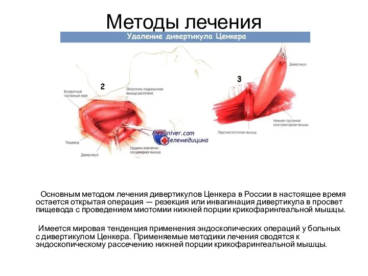 Методы лечения Основным методом лечения дивертикулов Ценкера в России в настоящее