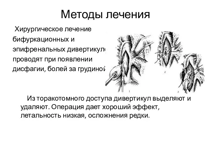 Методы лечения Хирургическое лечение бифуркационных и эпифренальных дивертикулов проводят при появлении