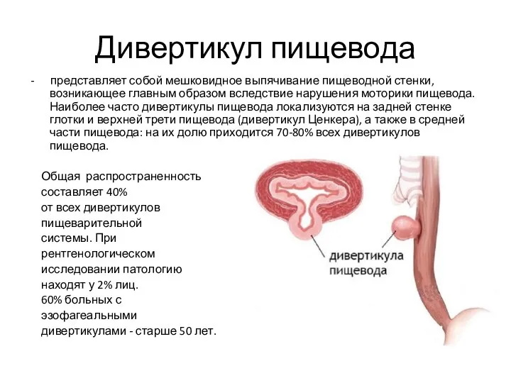 Дивертикул пищевода - представляет собой мешковидное выпячивание пищеводной стенки, возникающее главным