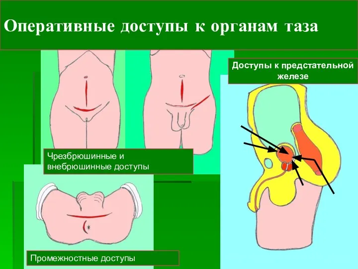 Доступы к предстательной железе Промежностные доступы Чрезбрюшинные и внебрюшинные доступы Оперативные доступы к органам таза