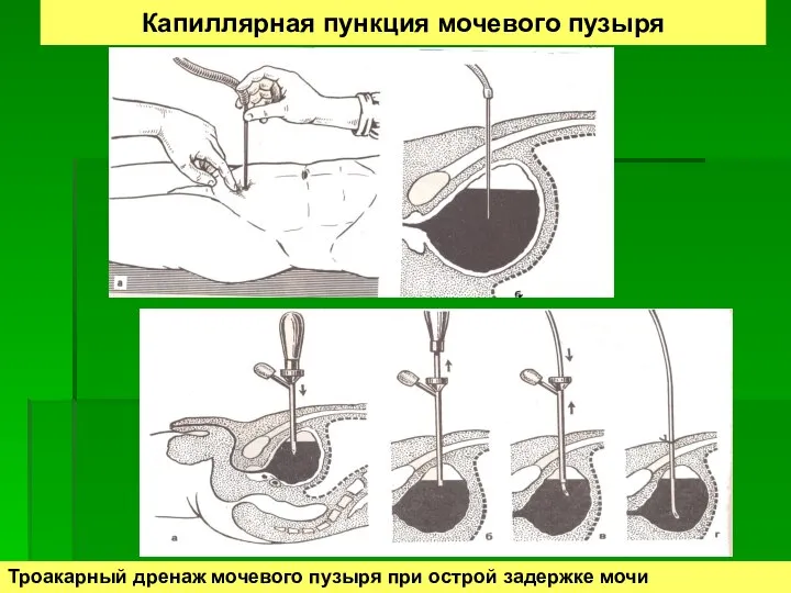 Капиллярная пункция мочевого пузыря Троакарный дренаж мочевого пузыря при острой задержке мочи