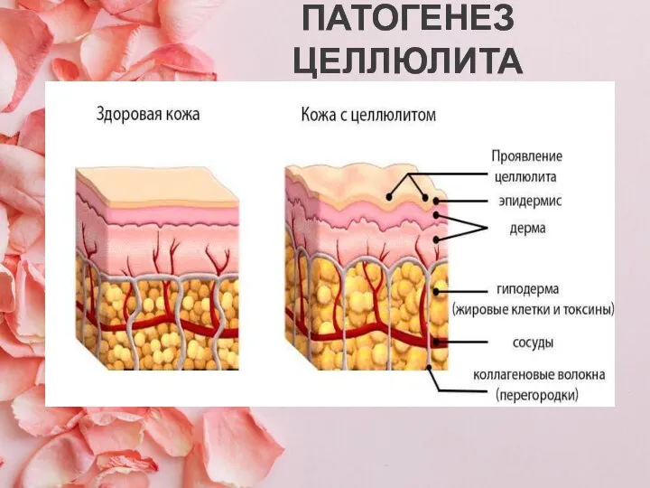 ПАТОГЕНЕЗ ЦЕЛЛЮЛИТА