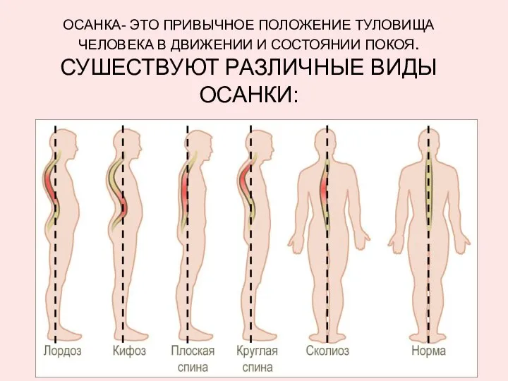 ОСАНКА- ЭТО ПРИВЫЧНОЕ ПОЛОЖЕНИЕ ТУЛОВИЩА ЧЕЛОВЕКА В ДВИЖЕНИИ И СОСТОЯНИИ ПОКОЯ. СУШЕСТВУЮТ РАЗЛИЧНЫЕ ВИДЫ ОСАНКИ: