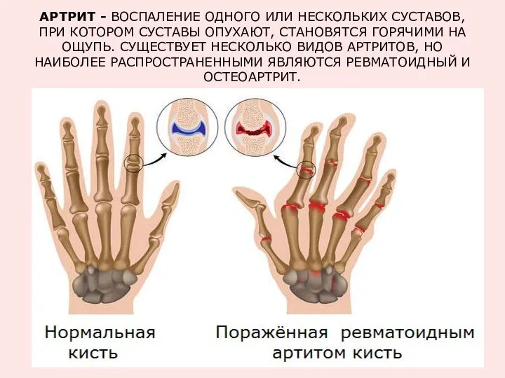 АРТРИТ - ВОСПАЛЕНИЕ ОДНОГО ИЛИ НЕСКОЛЬКИХ СУСТАВОВ, ПРИ КОТОРОМ СУСТАВЫ ОПУХАЮТ,