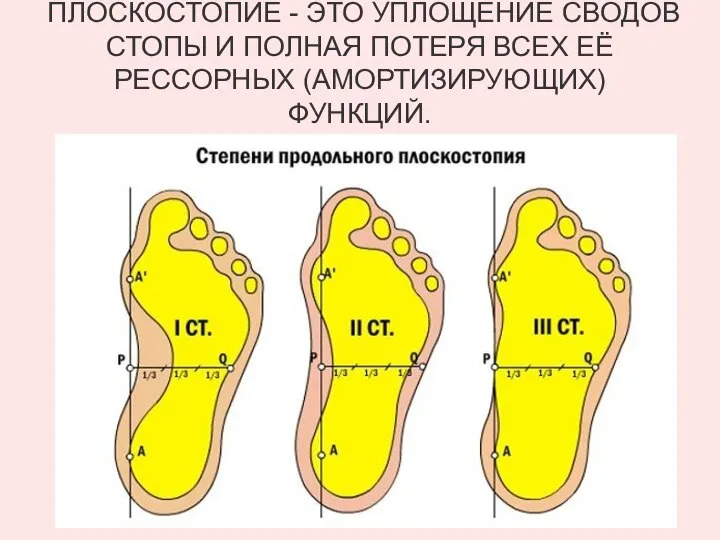 ПЛОСКОСТОПИЕ - ЭТО УПЛОЩЕНИЕ СВОДОВ СТОПЫ И ПОЛНАЯ ПОТЕРЯ ВСЕХ ЕЁ РЕССОРНЫХ (АМОРТИЗИРУЮЩИХ) ФУНКЦИЙ.