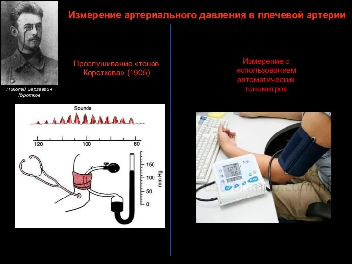 Измерение артериального давления в плечевой артерии Прослушивание «тонов Короткова» (1905) Николай