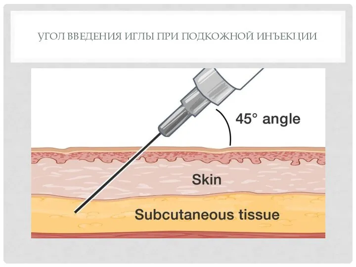 УГОЛ ВВЕДЕНИЯ ИГЛЫ ПРИ ПОДКОЖНОЙ ИНЪЕКЦИИ
