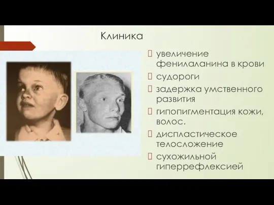 Клиника увеличение фенилаланина в крови судороги задержка умственного развития гипопигментация кожи, волос. диспластическое телосложение сухожильной гиперрефлексией