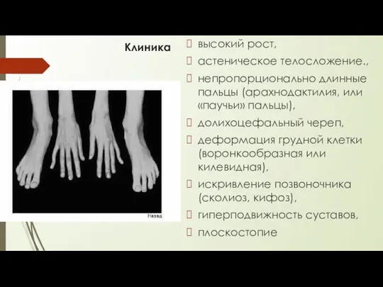 Клиника высокий рост, астеническое телосложение., непропорционально длинные пальцы (арахнодактилия, или «паучьи»