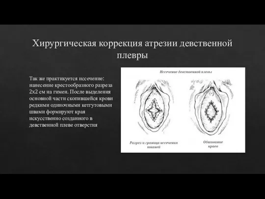 Хирургическая коррекция атрезии девственной плевры Так же практикуется иссечение: нанесение крестообразного