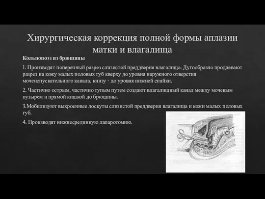 Хирургическая коррекция полной формы аплазии матки и влагалища Кольпопоэз из брюшины