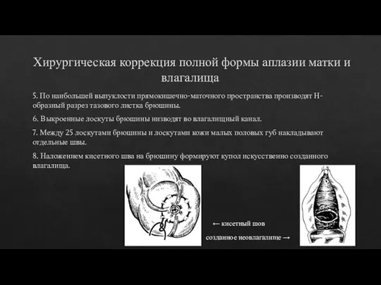 Хирургическая коррекция полной формы аплазии матки и влагалища 5. По наибольшей