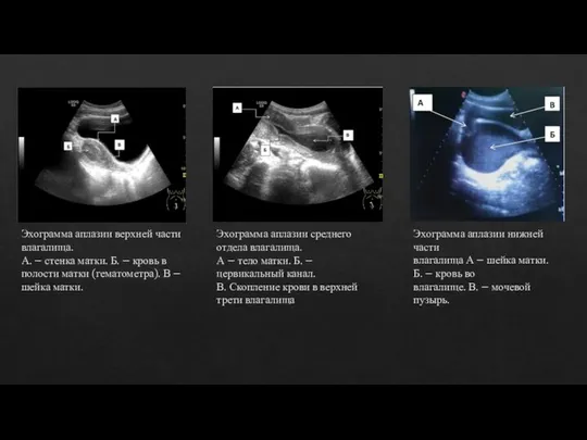 Эхограмма аплазии верхней части влагалища. А. – стенка матки. Б. –