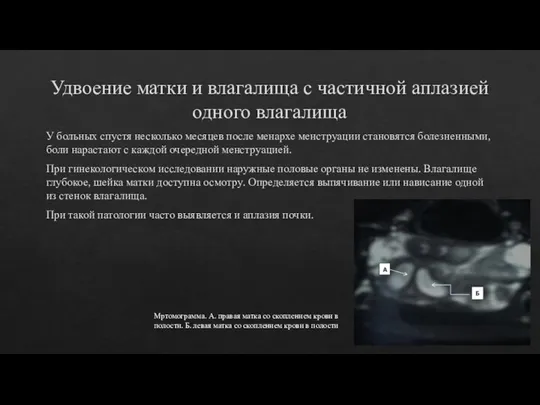 Удвоение матки и влагалища с частичной аплазией одного влагалища У больных