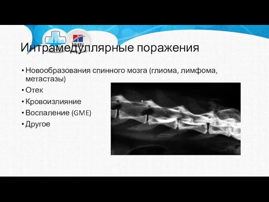 Интрамедуллярные поражения Новообразования спинного мозга (глиома, лимфома, метастазы) Отек Кровоизлияние Воспаление (GME) Другое