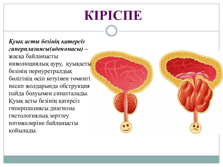 КІРІСПЕ Қуық асты безінің қатерсіз гиперплазиясы(аденомасы) – жасқа байланысты инволюциялық ауру,